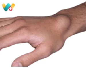 Ganglion