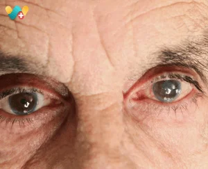 Glaucoma