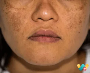 Pigmentation - झाइंया