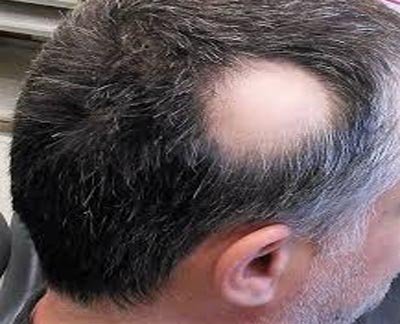 Alopecia Areata
