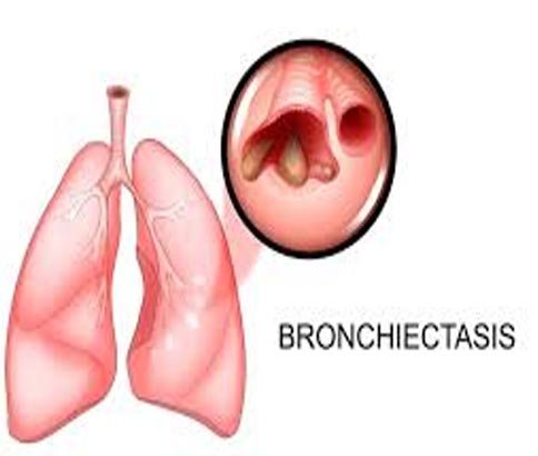 Bronchiectasis