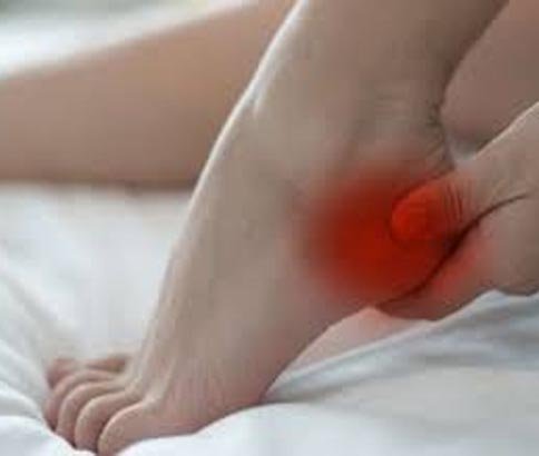 Calcaneal Spur