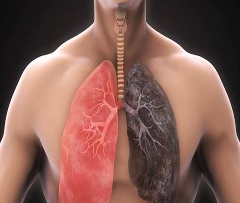 Chronic Obstructive Pulmonary Disease (COPD)
