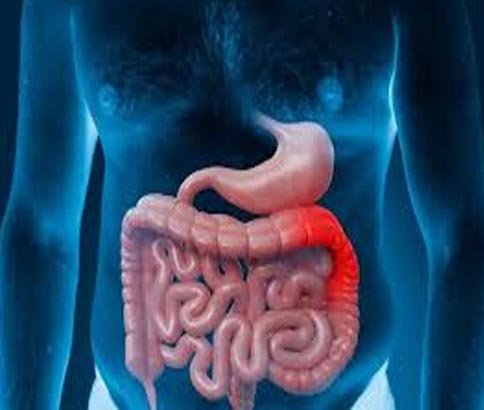 Colitis