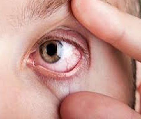 Dry Eye