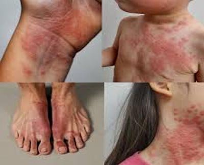 Eczema