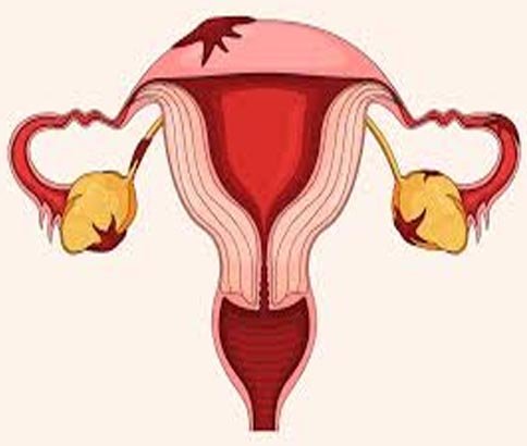 Endometriosis