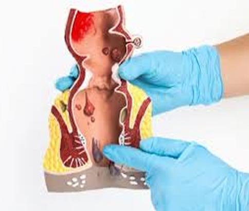 Fistula
