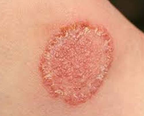 Fungal Infection