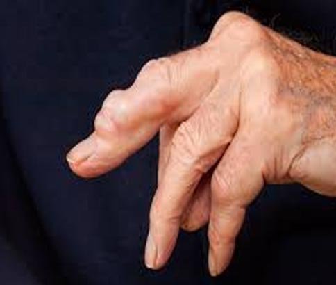 Ganglion