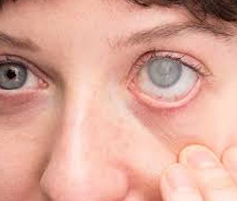 Glaucoma