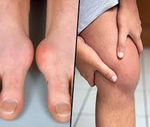 Gout