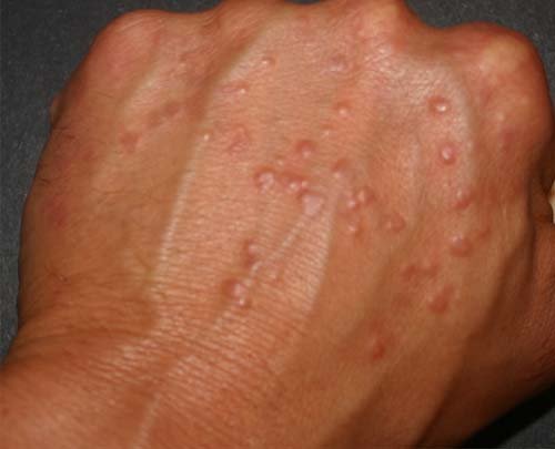 Granuloma Annulare