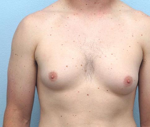 Gynecomastia