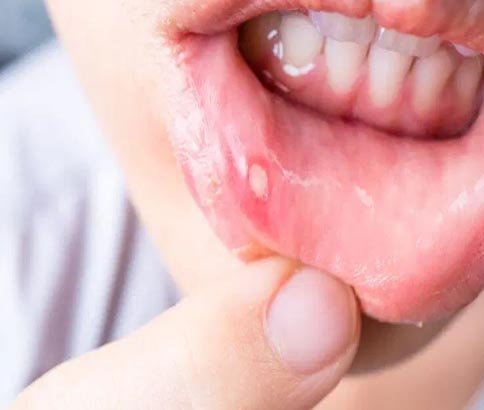 Mouth Ulcers