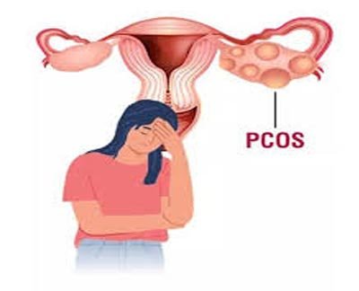 PCOS PCOD/ Cyst / Fibroid