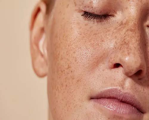 Pigmentation - झाइंया