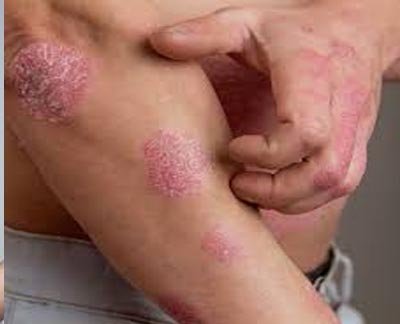 Psoriasis
