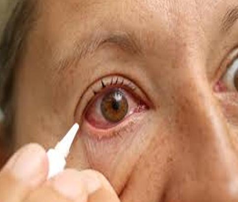 Redness in Eyes 
