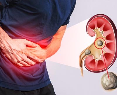 Renal Stone