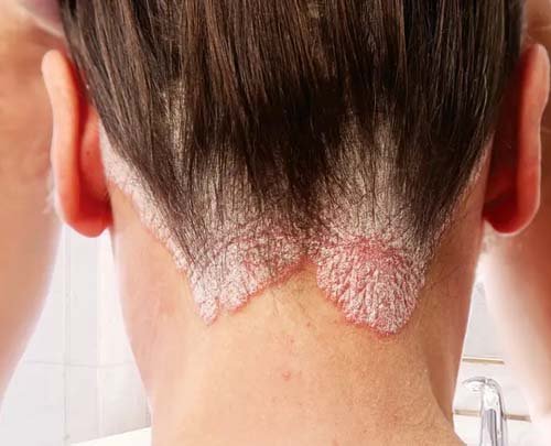 Scalp psoriasis