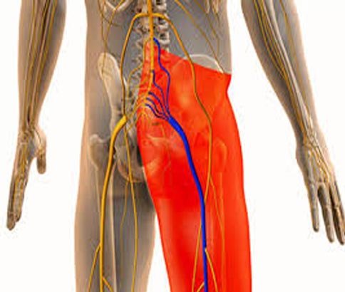 Sciatica