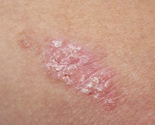 Skin Psoriasis