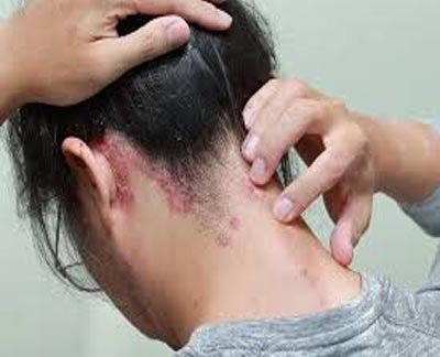 Skin Disorders