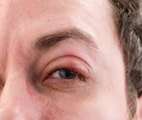 Trachoma