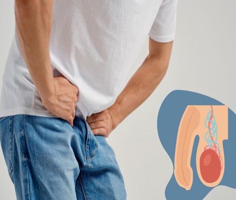 Varicocele