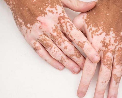 Vitiligo / Leucoderma - सफ़ेद दाग 