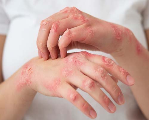 Allergy