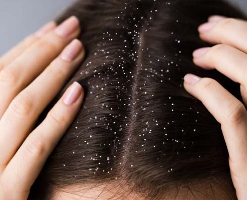 Dandruff