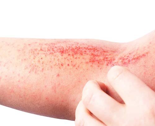 Eczema - खुज़ली की समस्या 