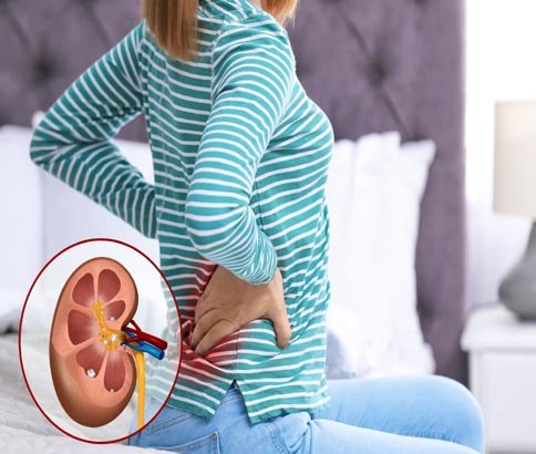 kidney Stones