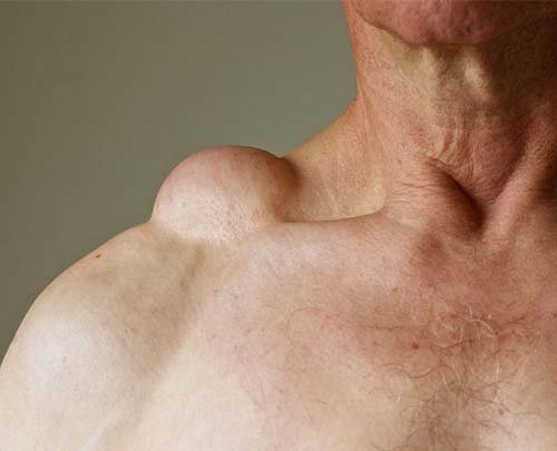 Lipoma - लाइपोमा