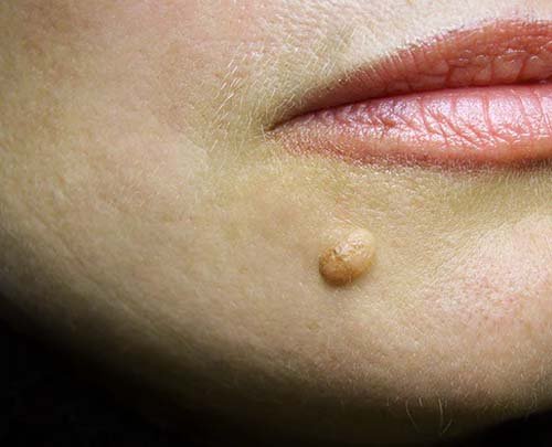 warts