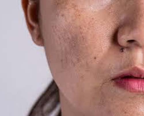 melasma