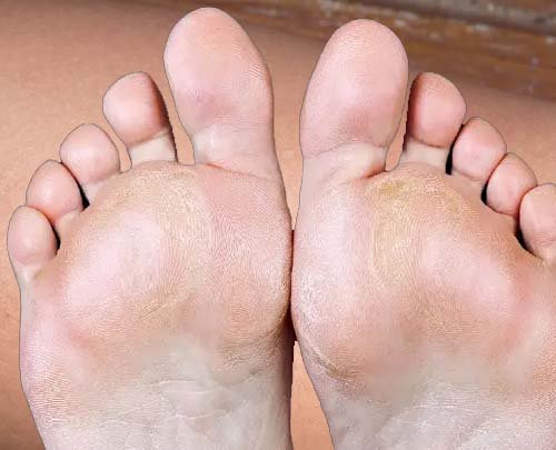 Callosities (corns)