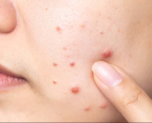 Acne / Pimple