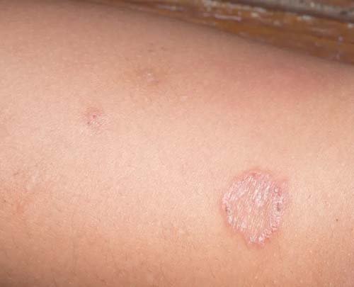 Ringworm